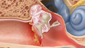 Cholesteatoma