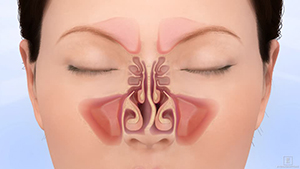 Deviated Nasal Septum