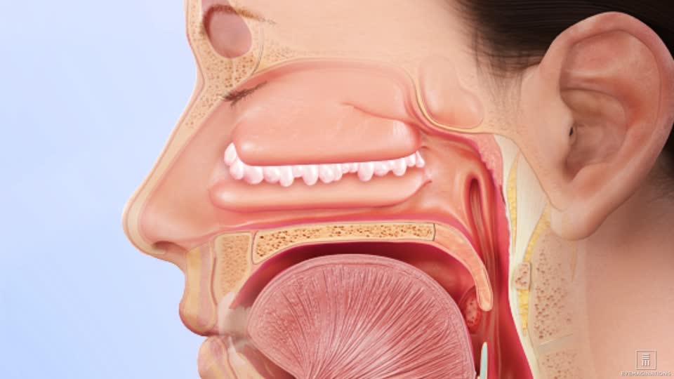 Nasal Polyps