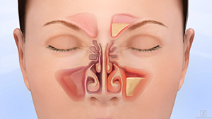 Sinusitis