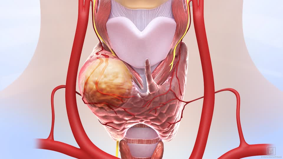 Thyroid Nodules