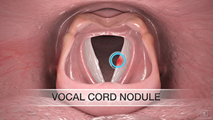 Vocal Cord Nodules and Polyps