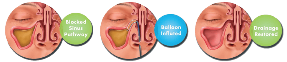 Balloon Sinus Dilation Process