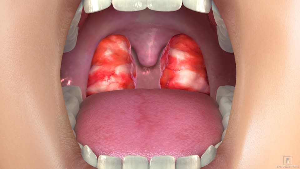 Thyroid Nodules